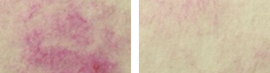 Resultados do tratamento na face